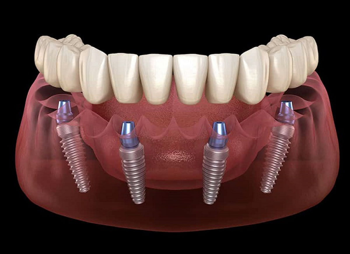 impianti dentali