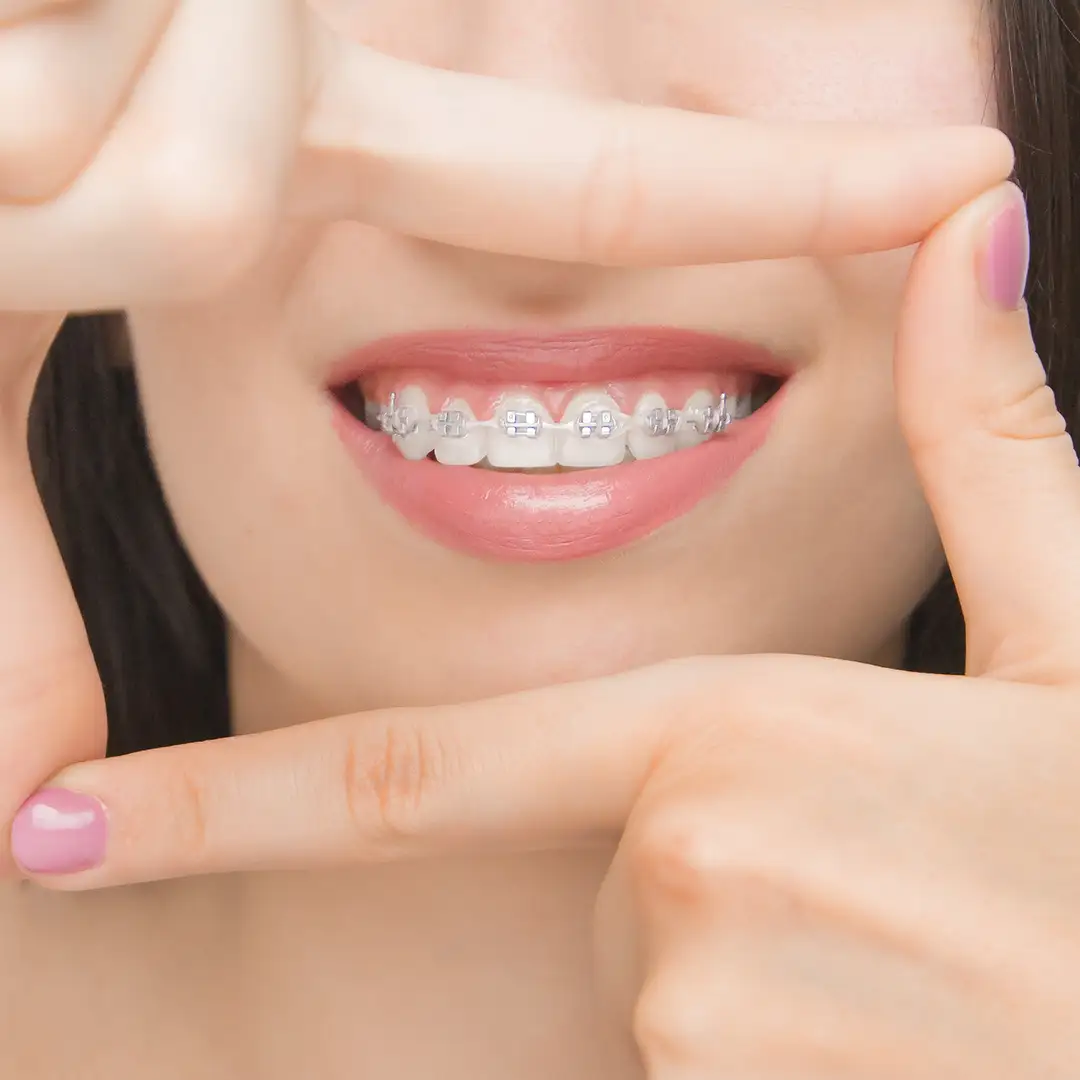 Apparecchio fisso - Studio Dentistico Giuva - Dentista Ostia Apparecchio fisso - Studio Dentistico Giuva - Dentista Ostia