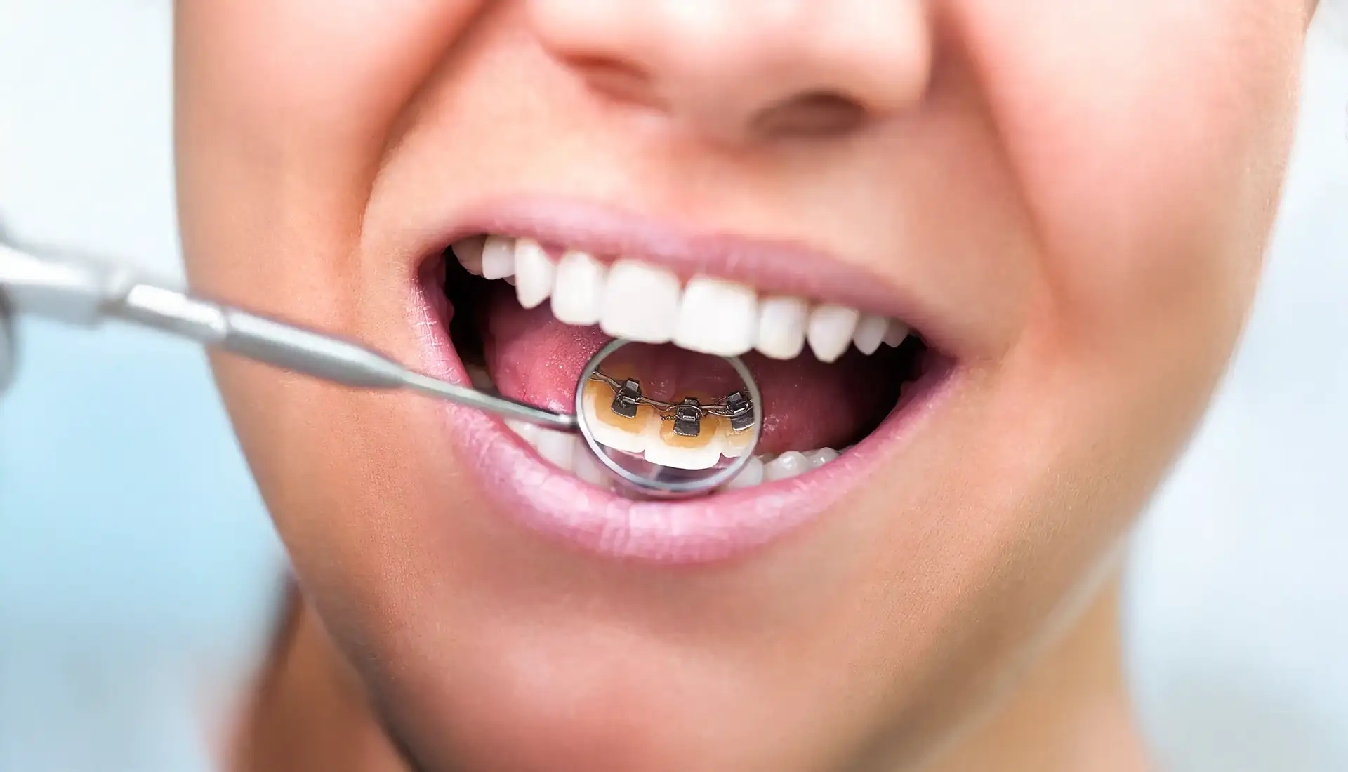 Ortodonzia Fissa - Studio Dentistico Giuva - Dentista Ostia