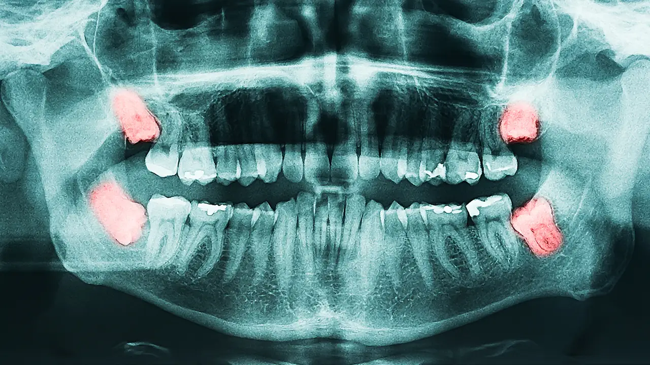 Chirurgia orale estrattiva - Studio Dentistico Giuva - Dentista Ostia Chirurgia orale estrattiva - Studio Dentistico Giuva - Dentista Ostia
