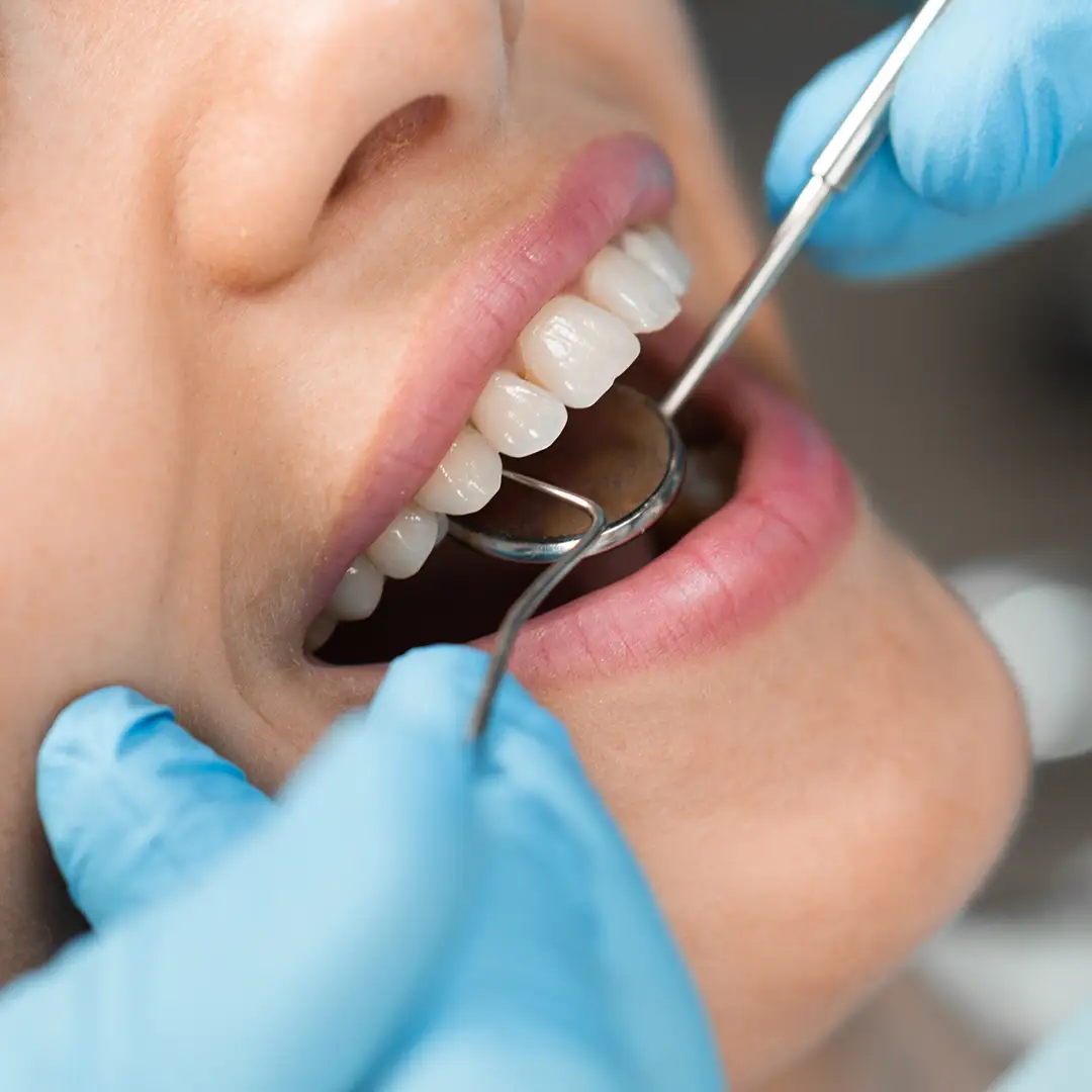 Curare la parodontite - Studio Dentistico Giuva - Dentista Ostia Curare la parodontite - Studio Dentistico Giuva - Dentista Ostia