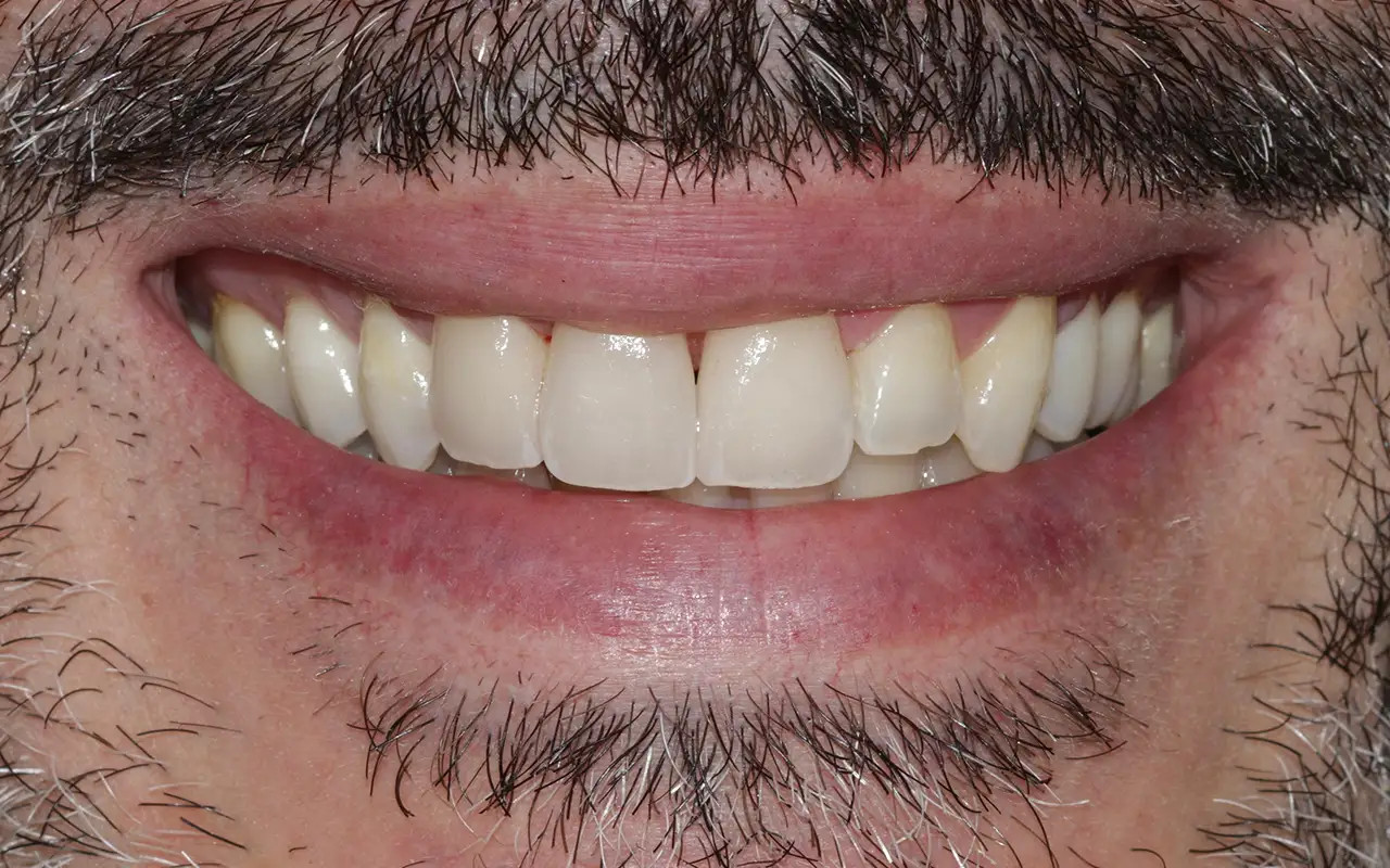 Odontoiatria Estetica Digitale - Dopo - Studio Dentistico Giuva - Dentista Ostia Odontoiatria Estetica Digitale - Dopo - Studio Dentistico Giuva - Dentista Ostia