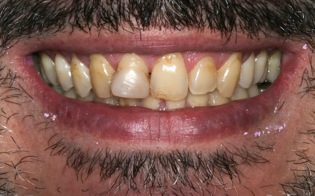 Odontoiatria Estetica Digitale - Prima - Studio Dentistico Giuva - Dentista Ostia Odontoiatria Estetica Digitale - Prima - Studio Dentistico Giuva - Dentista Ostia