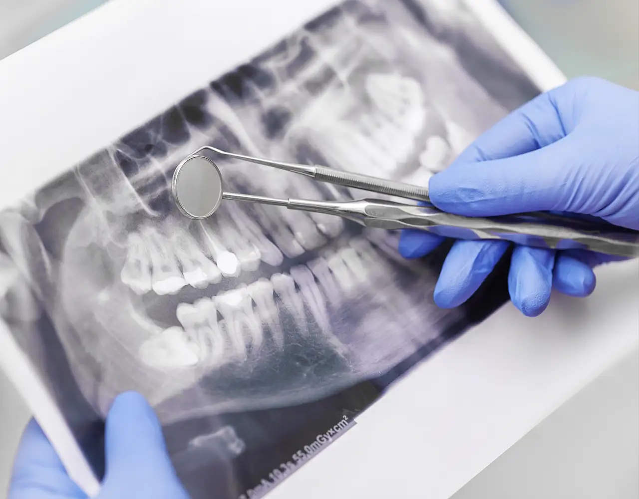 Salvare il dente quando il nervo è compromesso - Studio Dentistico Giuva - Dentista Ostia