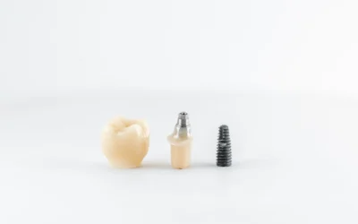 Impianti dentali: carico immediato o differito?