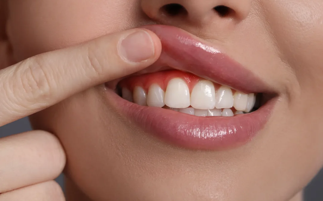 Parodontite e sindrome metabolica: un legame da spezzare
