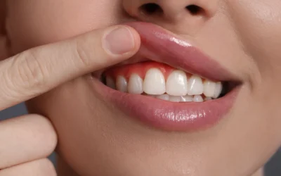 Parodontite e sindrome metabolica: un legame da spezzare